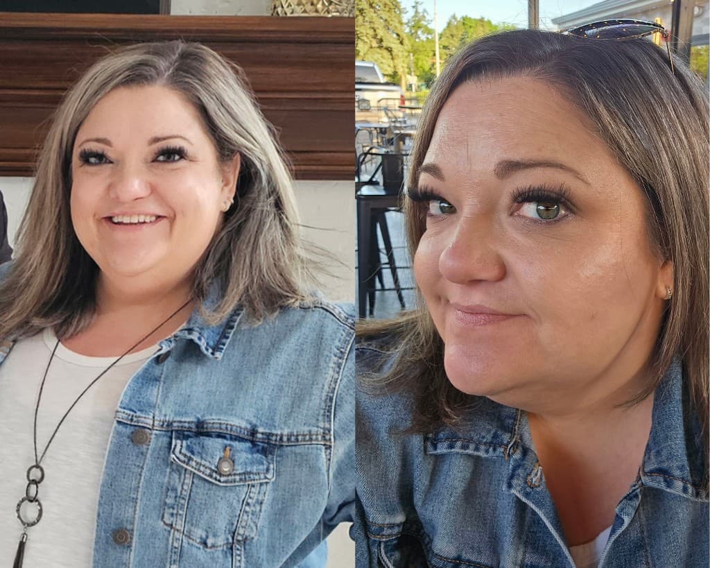 Skin tightening before and after Hello Gorgeous Med Spa Oswego IL