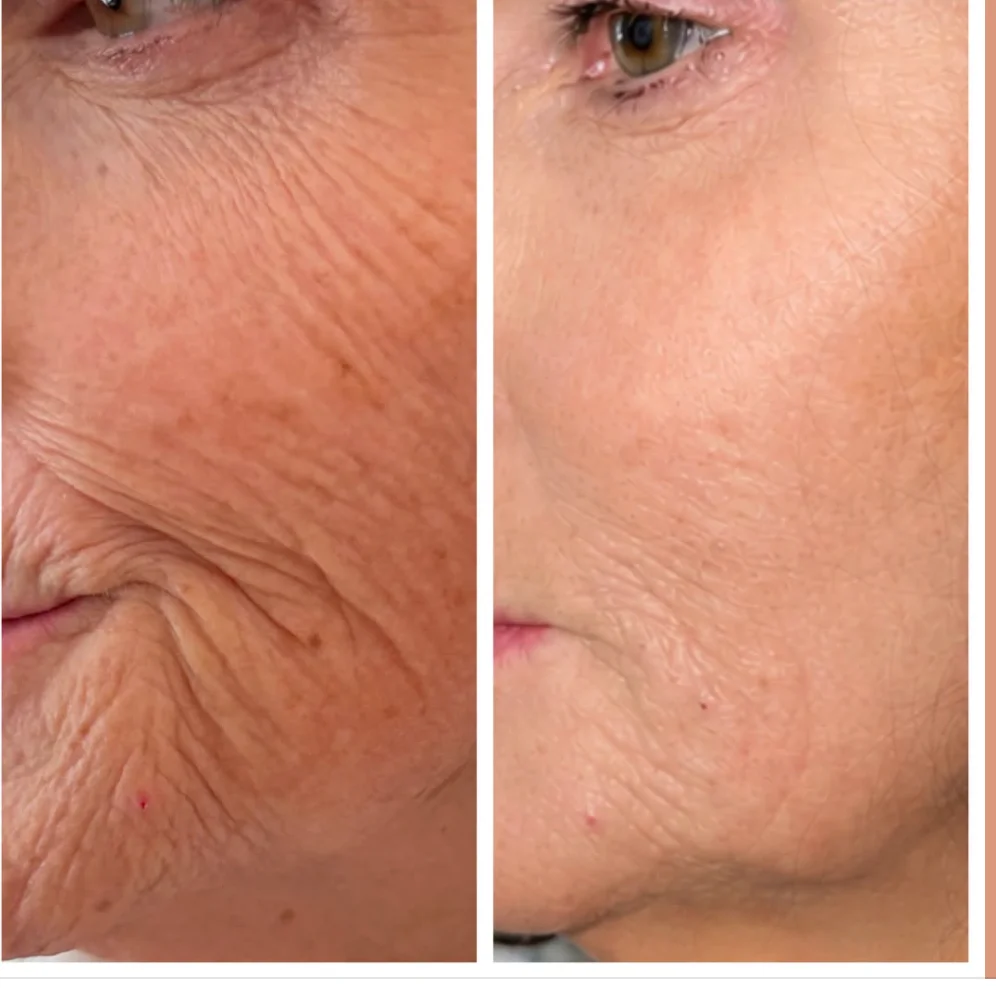 Close-up of a lower cheek and mouth area before and after hyaluronic acid filler. Individual results vary.