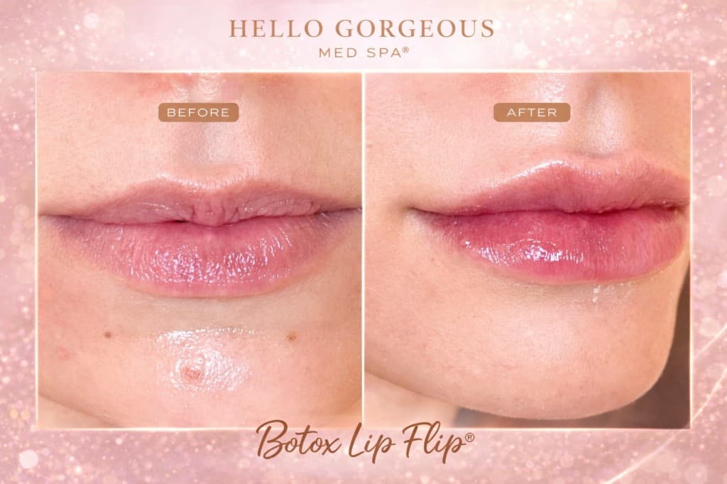 Botox Lip Flip before and after results at Hello Gorgeous Med Spa