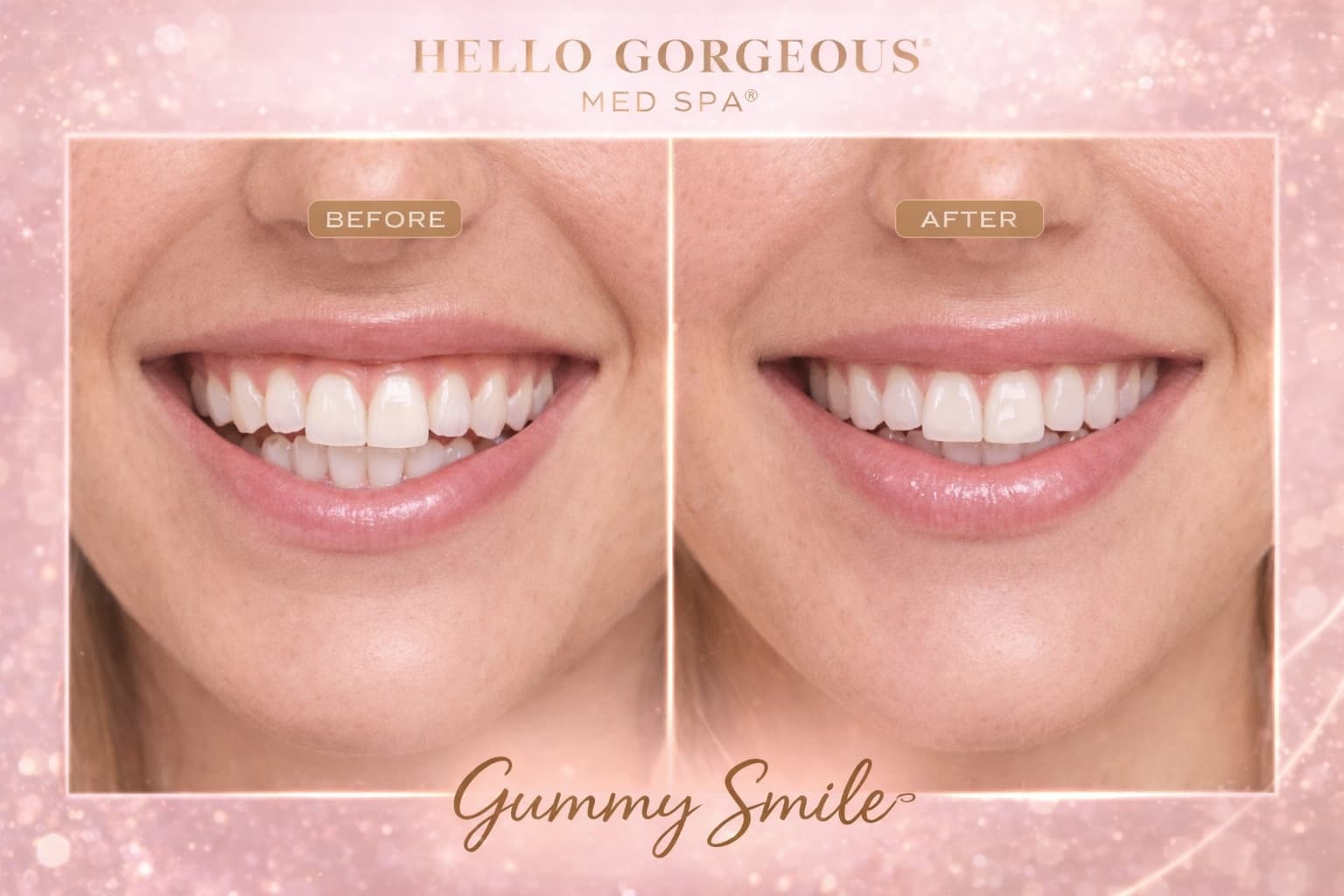 Gummy Smile Botox treatment before and after at Hello Gorgeous Med Spa