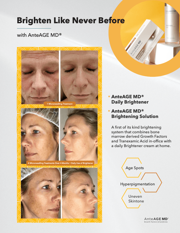 AnteAGE MD brightening before and after — microneedling and growth factor skincare at Hello Gorgeous Med Spa Oswego IL