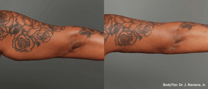 Arm skin tightening before and after