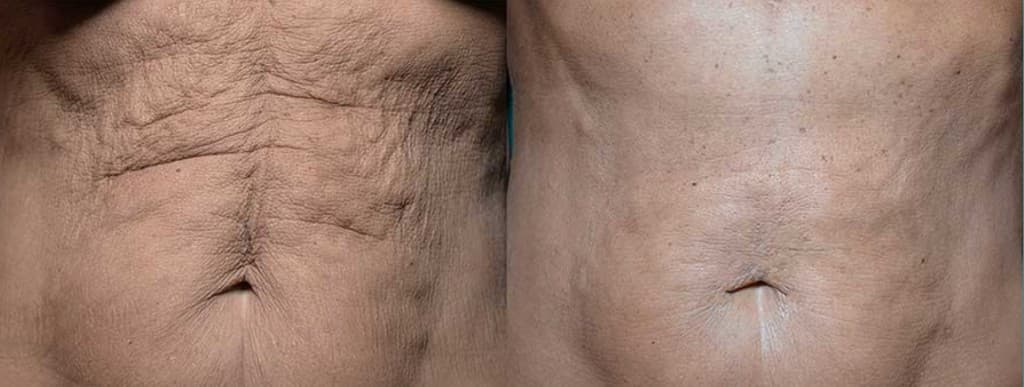 Morpheus8 Burst + Deep abdomen skin tightening before and after — loose post-pregnancy and post-weight-loss belly skin firmed at Hello Gorgeous Med Spa Oswego IL