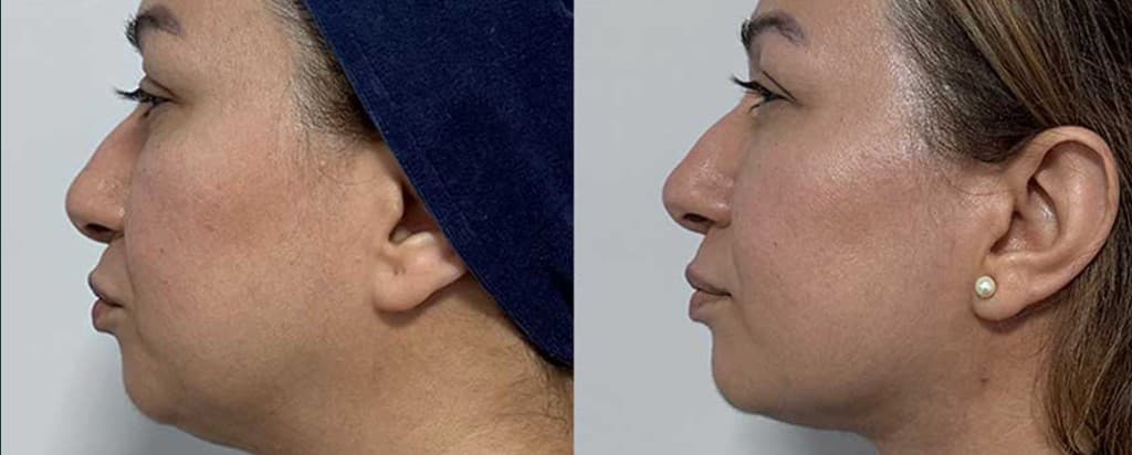 Morpheus8 Burst + Deep bat-wing arms before and after — loose upper arm skin tightened at Hello Gorgeous Med Spa, Oswego IL