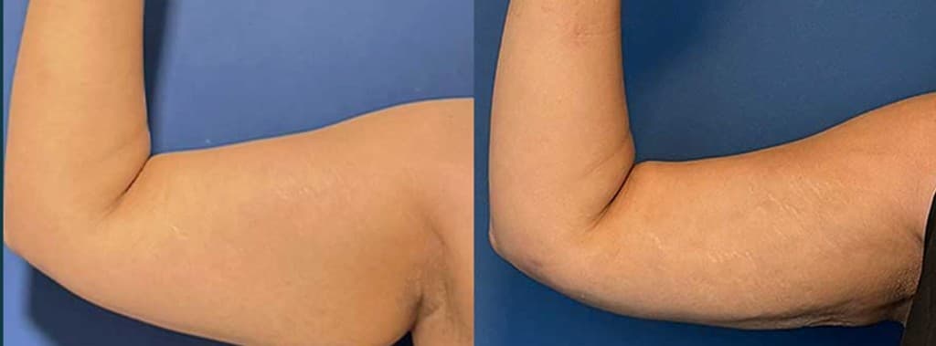 Morpheus8 Burst + Deep double chin and submental fullness before and after — neck profile transformed at Hello Gorgeous Med Spa Oswego IL