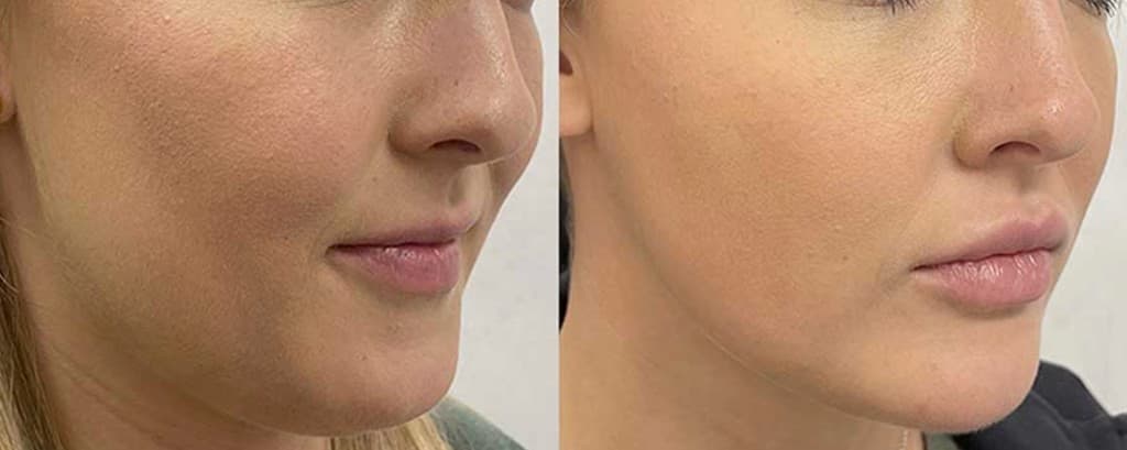 Morpheus8 Burst + Deep face profile lift before and after — jowls and lower-face laxity remodeled at Hello Gorgeous Med Spa, Oswego IL