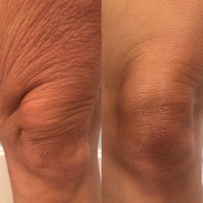 Morpheus8 Burst + Deep knee and elbow skin tightening before and after — crepey wrinkled skin transformed at Hello Gorgeous Med Spa