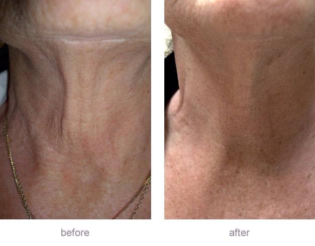 Morpheus8 Burst + Deep neck tightening before and after — crepey neck skin smoothed and lifted in real Hello Gorgeous Med Spa patient, Oswego IL