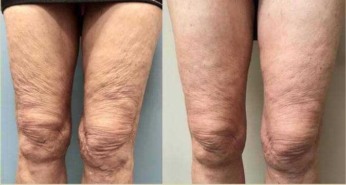 Morpheus8 Burst + Deep thigh skin tightening before and after — sagging crepey thigh skin firmed and tightened, Hello Gorgeous Med Spa Oswego IL
