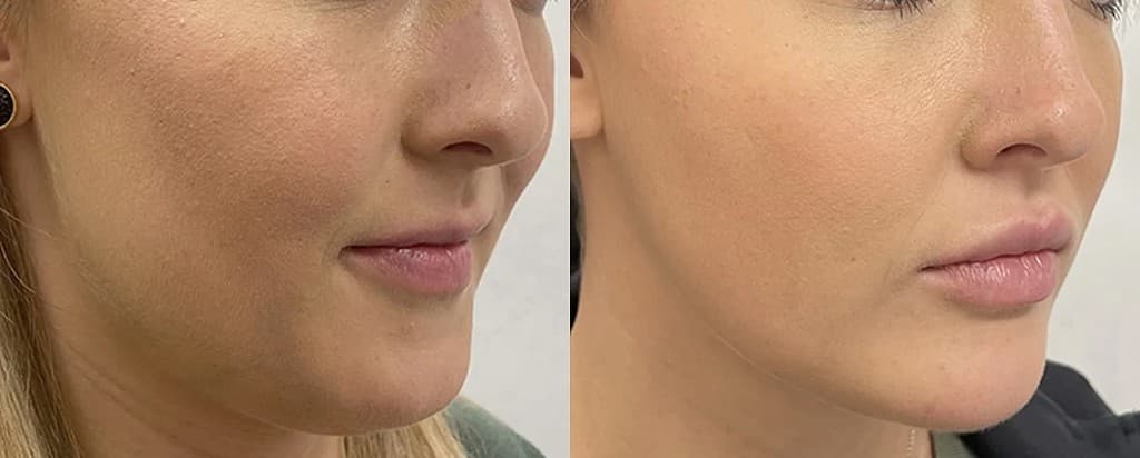 QuantumRF 10 before and after - facial contouring