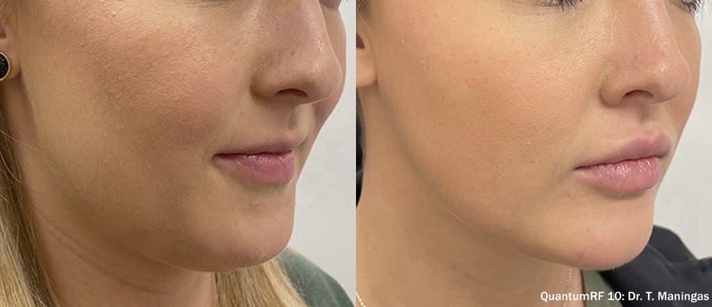 QuantumRF 10 before and after - jawline tightening and contouring