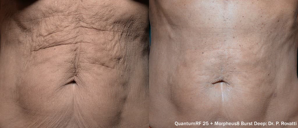 QuantumRF 25 before and after - abdomen skin tightening