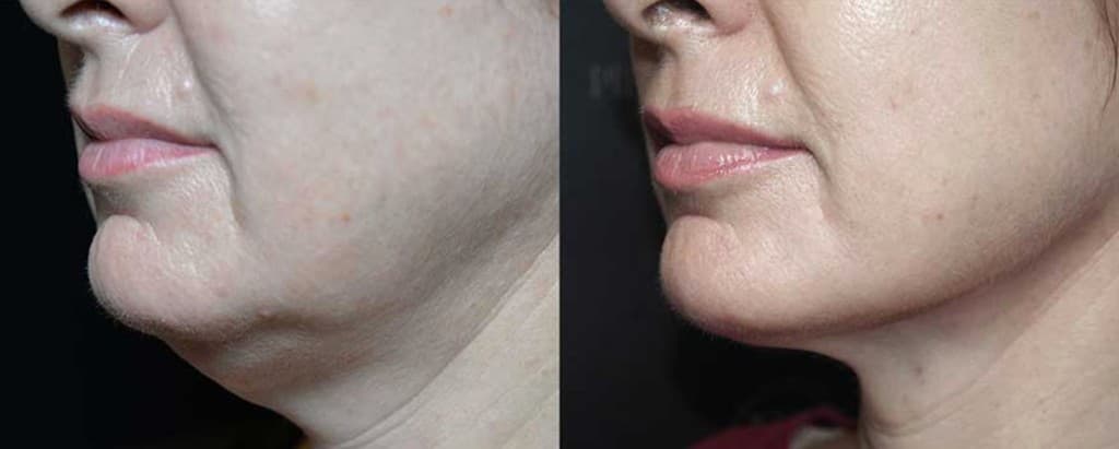 Quantum RF jawline and neck tightening before and after — Hello Gorgeous