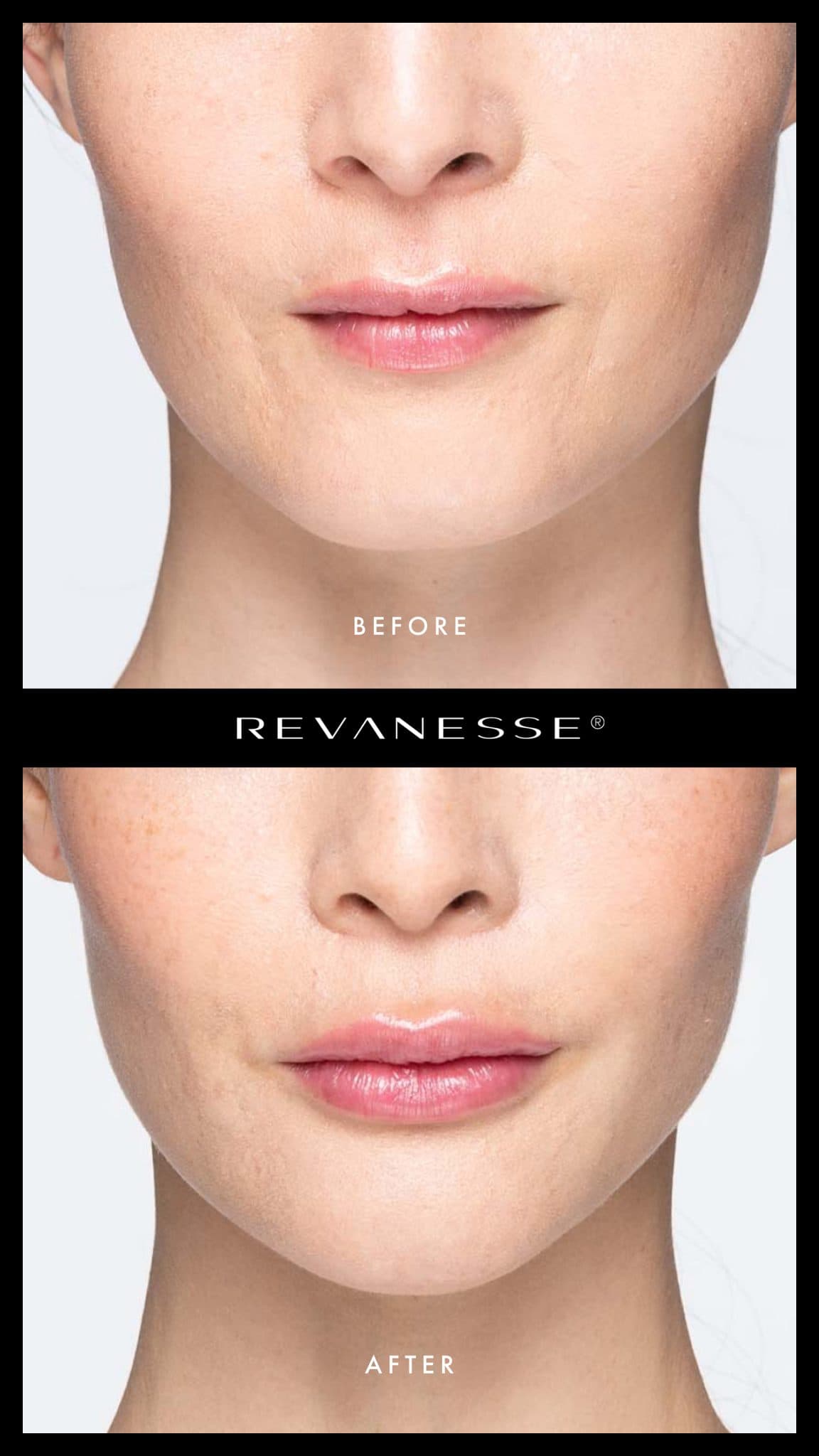 Lip filler before and after - Patient 1