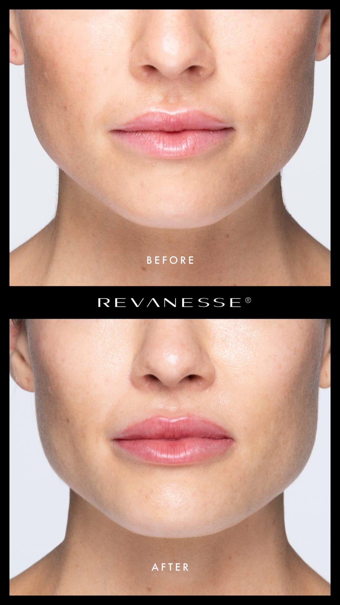 Lip filler before and after - Patient 2