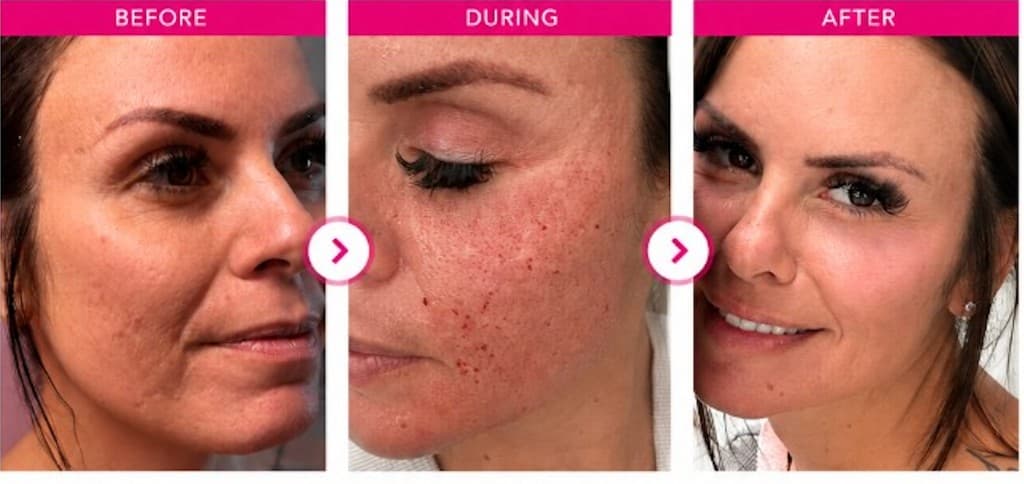 Danielle Alcala-Glazier Solaria CO₂ before, during, and after — founder of Hello Gorgeous Med Spa, Oswego IL