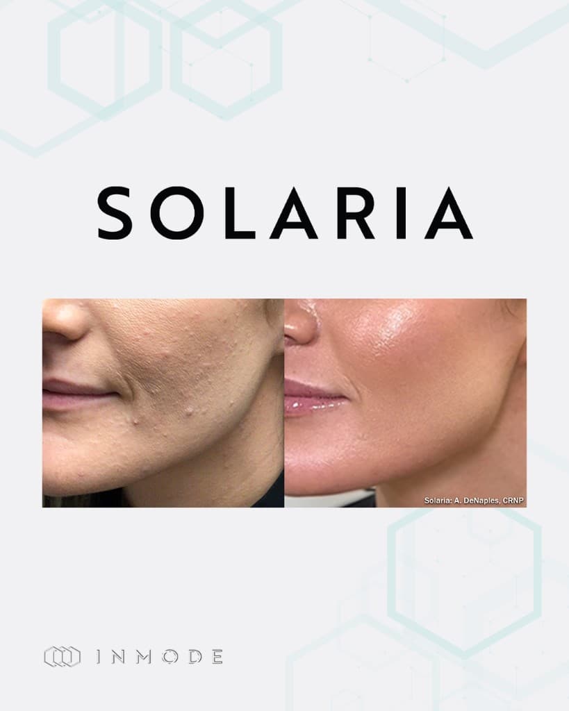 Solaria CO2 acne scar before and after — ice pick and boxcar acne scars smoothed with InMode Solaria fractional CO2 resurfacing
