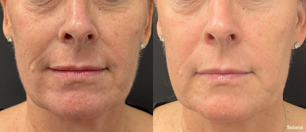 Solaria CO2 full face before and after — fine lines, deep wrinkles, and skin laxity dramatically improved after one treatment with InMode Solaria fractional laser