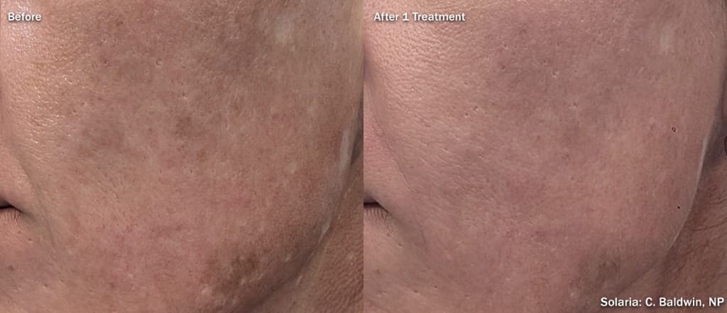 Solaria CO2 pigmentation before and after left cheek — uneven skin tone and brown spots resolved after a single InMode Solaria fractional laser session