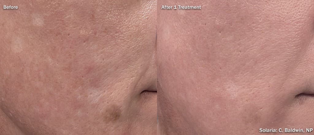 Solaria CO2 pigmentation before and after right cheek — sun damage, age spots and hyperpigmentation cleared after one InMode Solaria treatment