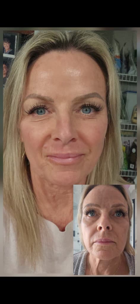 Before and after one Solaria CO₂ treatment: facial skin tightening, texture, and fine lines — Hello Gorgeous Med Spa Oswego IL