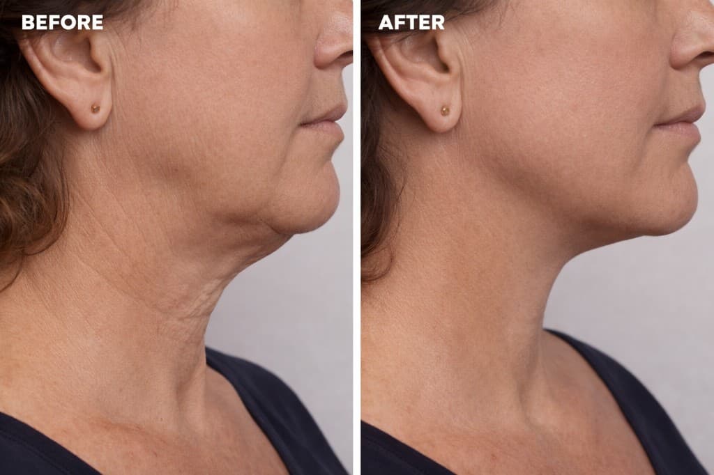 Before and after skin tightening: jawline and neck rejuvenation with Solaria CO₂ at Hello Gorgeous Med Spa