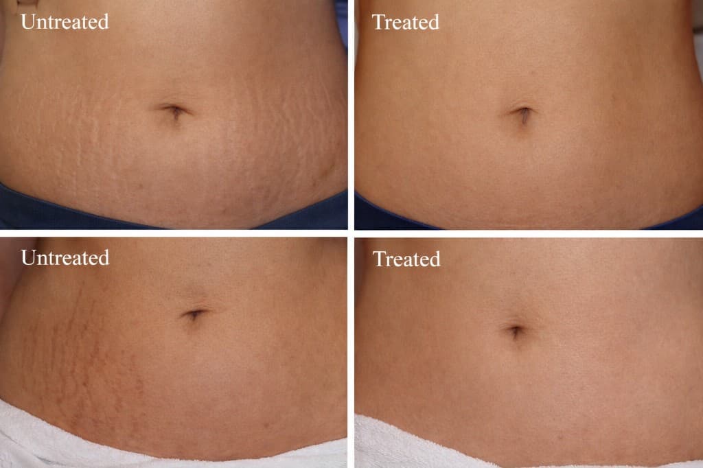 Stretch mark refinement before and after Solaria CO₂ fractional laser — Hello Gorgeous Med Spa Oswego Naperville IL