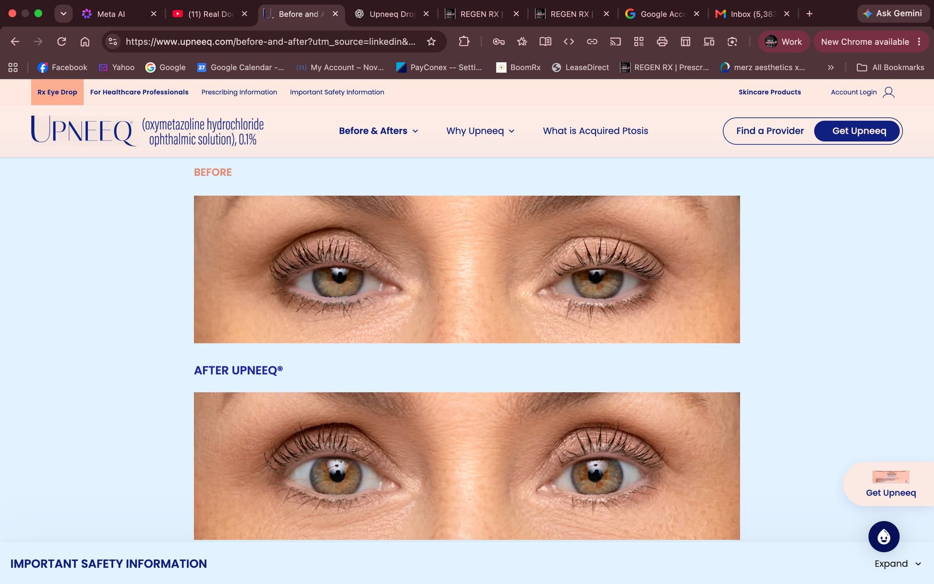 Upneeq before and after