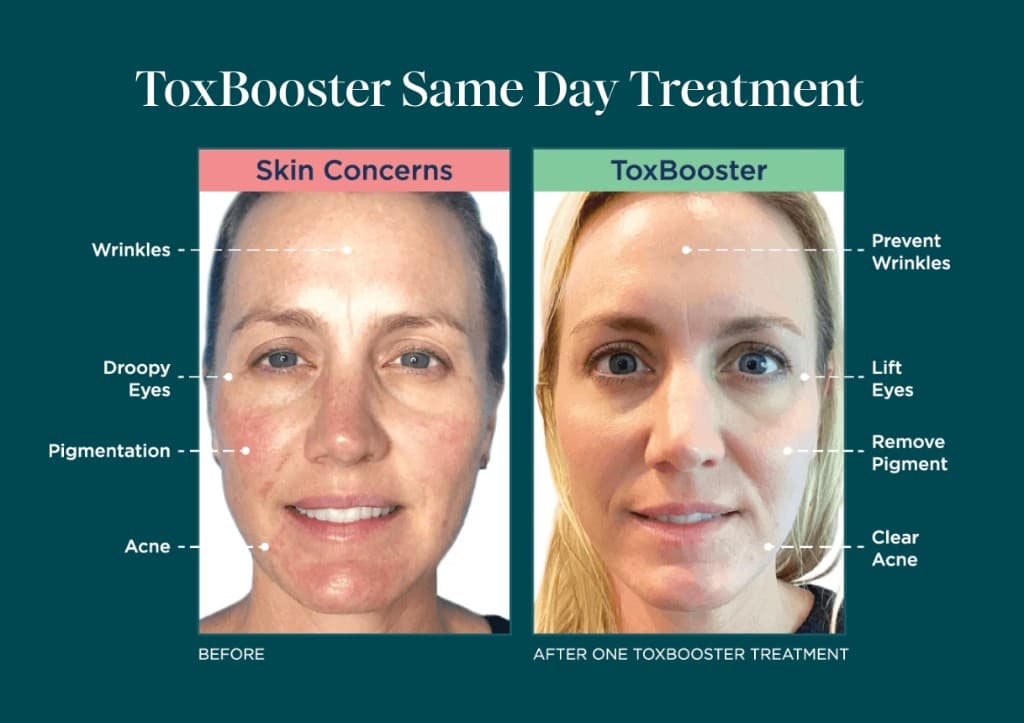 ToxBooster same-day treatment example. Skin concerns before, and the look after one ToxBooster treatment. Individual results vary.
