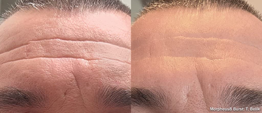 Morpheus8 Burst forehead wrinkles before and after