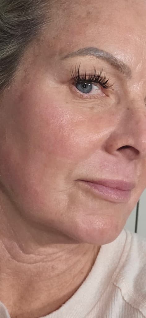 Solaria CO₂ Laser after — Hello Gorgeous Med Spa Oswego IL