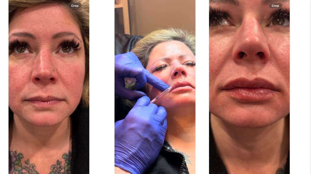 Lip filler before, during procedure, and after — Hello Gorgeous Med Spa Oswego IL