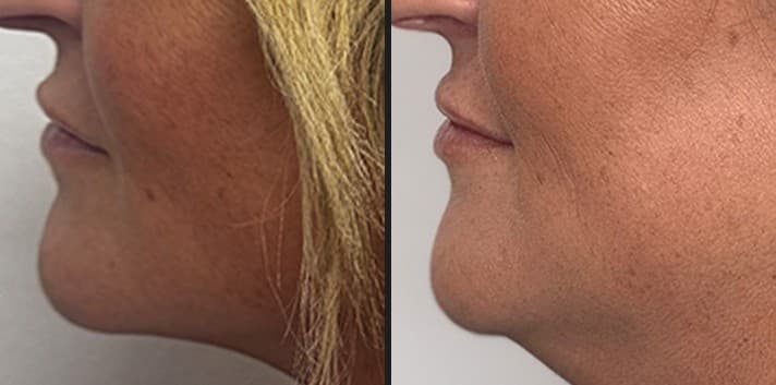 Luxora InMode body contouring before and after — Hello Gorgeous Med Spa Oswego IL