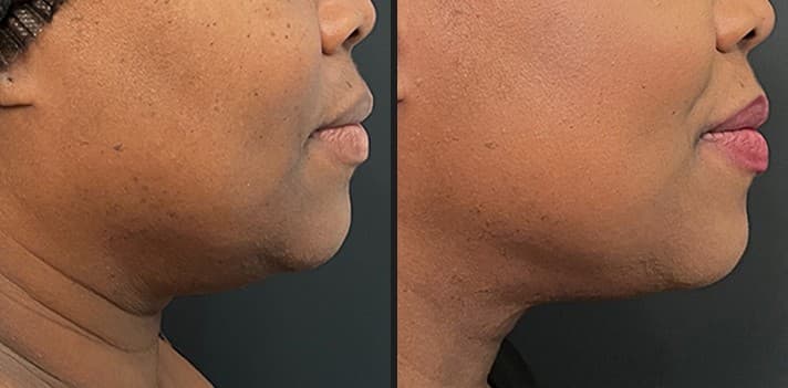 Luxora InMode skin laxity before and after — Hello Gorgeous Med Spa Oswego IL