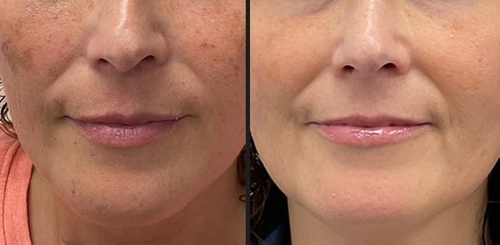 Luxora InMode circumference reduction before and after — Hello Gorgeous Med Spa Oswego IL