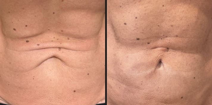 Luxora InMode fat reduction before and after — Hello Gorgeous Med Spa Oswego IL