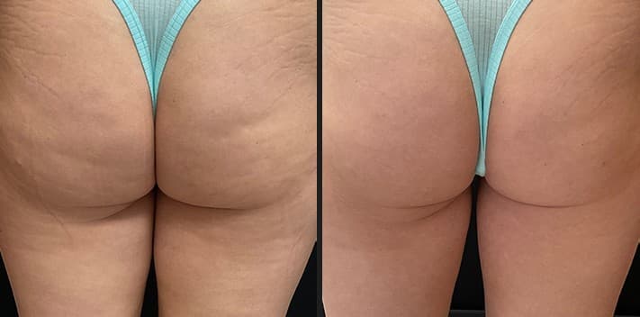 Luxora InMode cellulite and texture before and after — Hello Gorgeous Med Spa Oswego IL