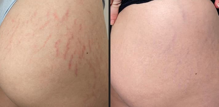 Luxora InMode full body result before and after — Hello Gorgeous Med Spa Oswego IL