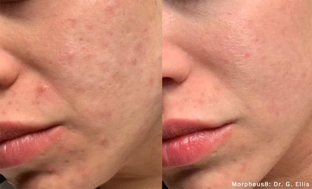 Morpheus8 acne scars before and after — Hello Gorgeous Med Spa Oswego IL