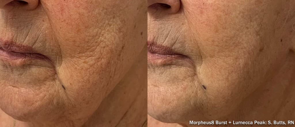 Morpheus8 Burst fine lines and skin laxity before and after — Hello Gorgeous Med Spa Oswego IL