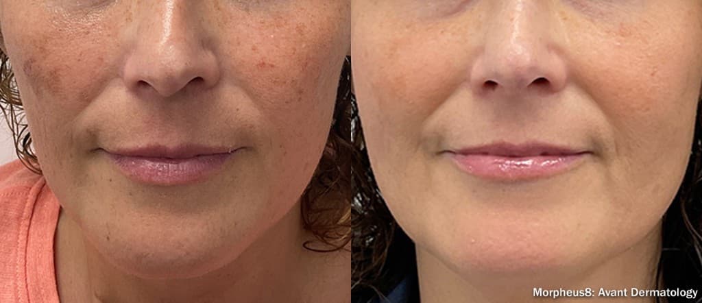 Morpheus8 face hyperpigmentation before and after — Hello Gorgeous Med Spa Oswego IL