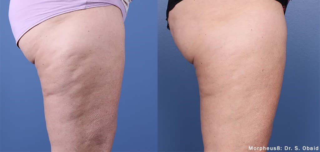 Morpheus8 Burst thigh cellulite before and after — Hello Gorgeous Med Spa Oswego IL