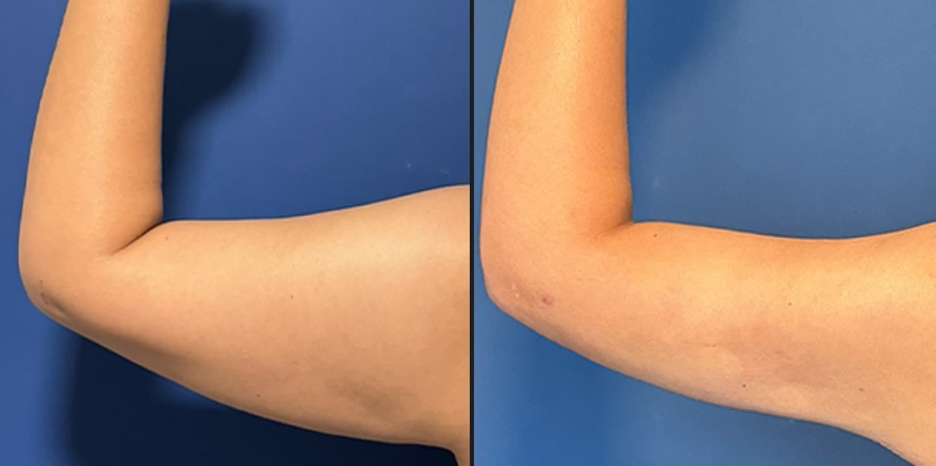 Quantum RF jawline definition before and after — Hello Gorgeous Med Spa Oswego IL