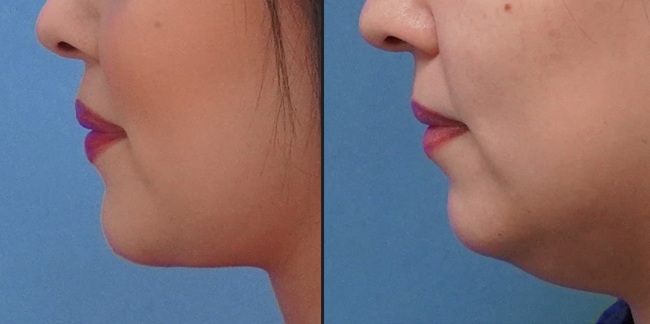 Quantum RF skin tightening before and after — Hello Gorgeous Med Spa Oswego IL