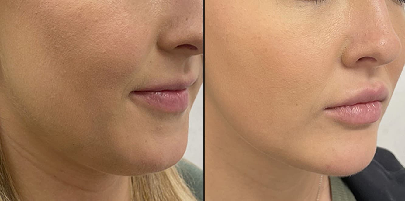 Quantum RF submental contouring before and after — Hello Gorgeous Med Spa Oswego IL