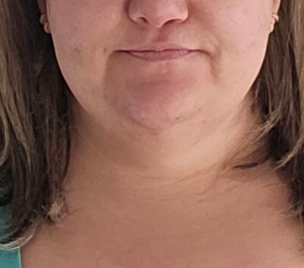 Quantum RF — Chin & Neck Contouring after — Hello Gorgeous Med Spa Oswego IL