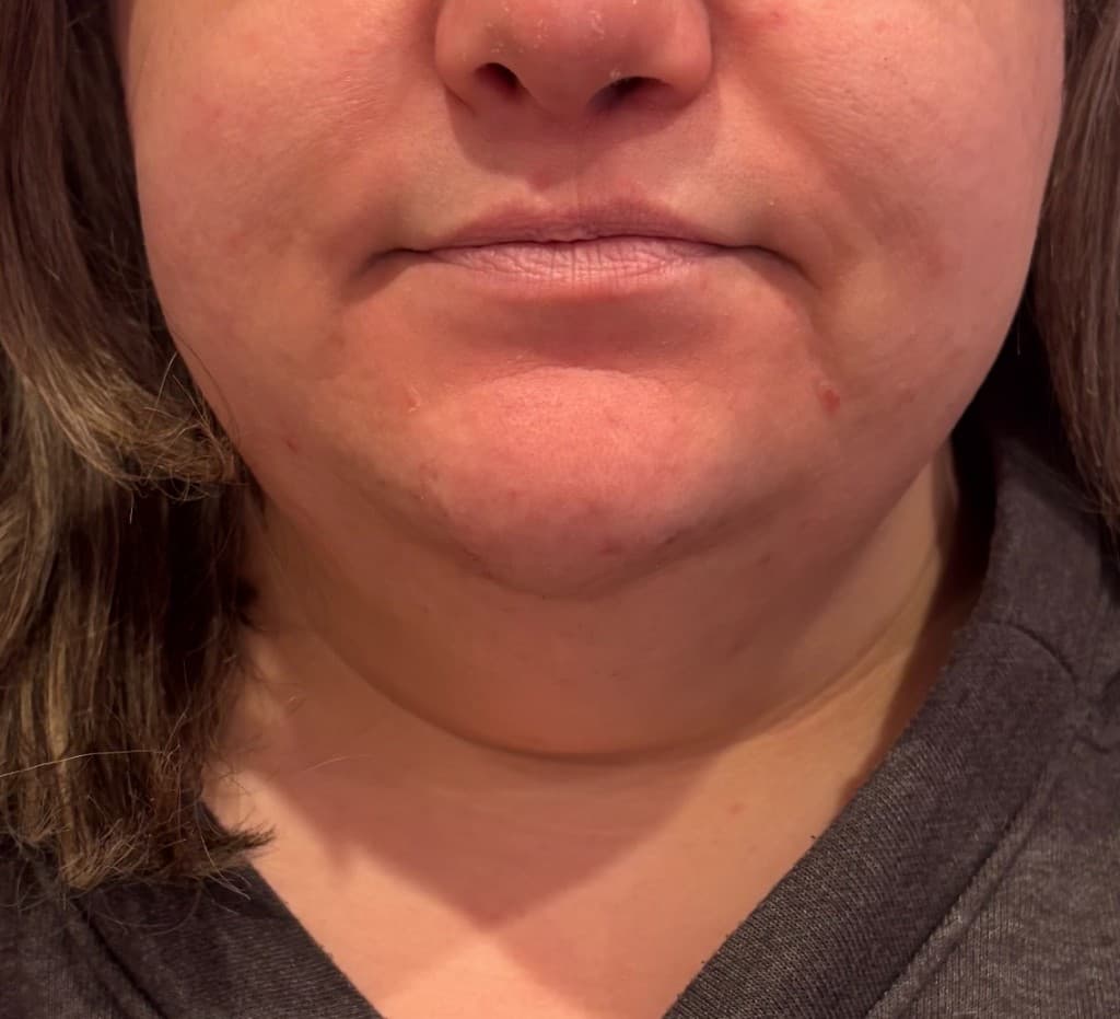Quantum RF — jawline before and after - Before