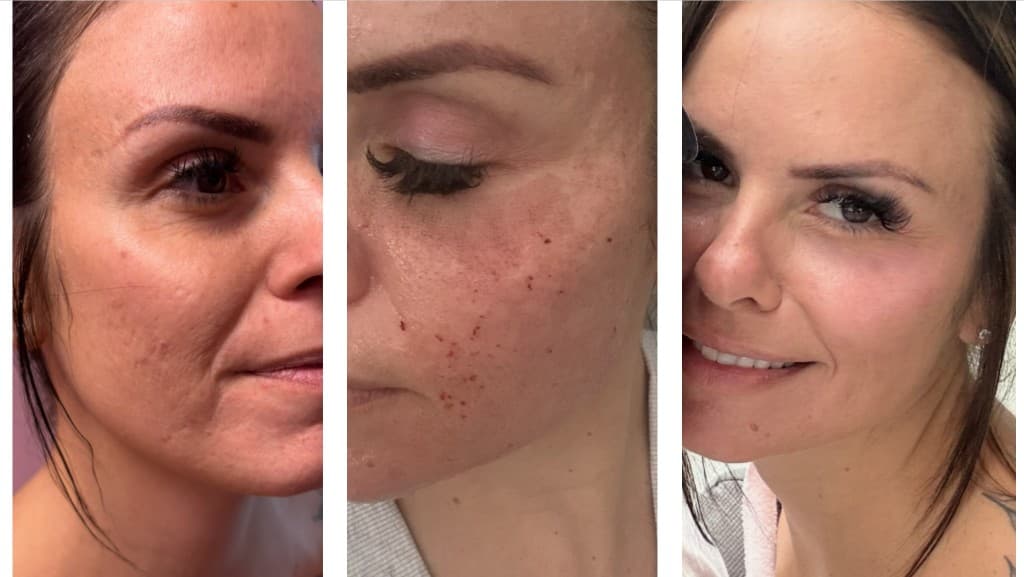 Solaria CO₂ laser before, during healing, and after — Hello Gorgeous Med Spa Oswego IL