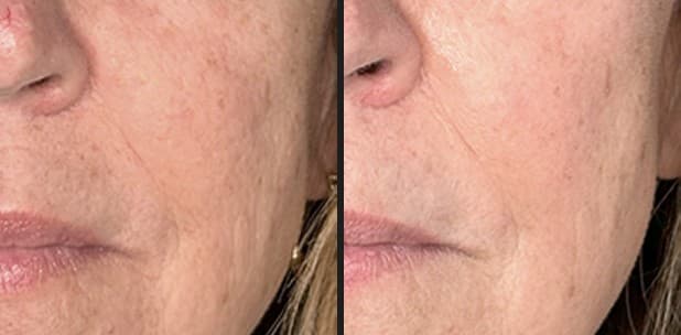 Solaria CO₂ wrinkles and collagen before and after — Hello Gorgeous Med Spa Oswego IL