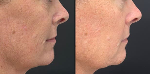 Solaria CO₂ acne scars before and after — Hello Gorgeous Med Spa Oswego IL